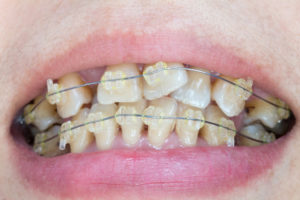 orthodontic treatment