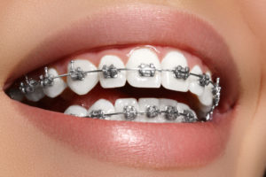 Braces for adults