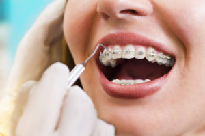 orthodontic treatment - braces